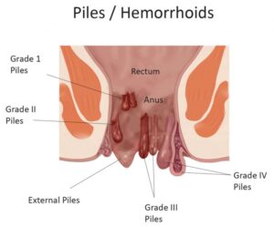 best piles hospital in tanda