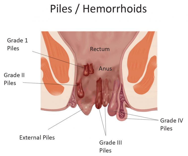 piles treatment