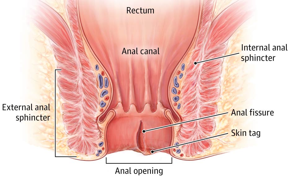 Anal Fissure Treatment In Hoshiarpur